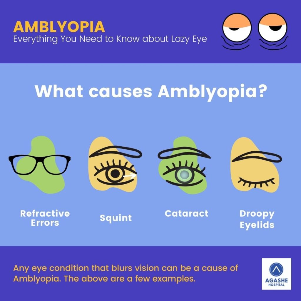causes of amblyopia