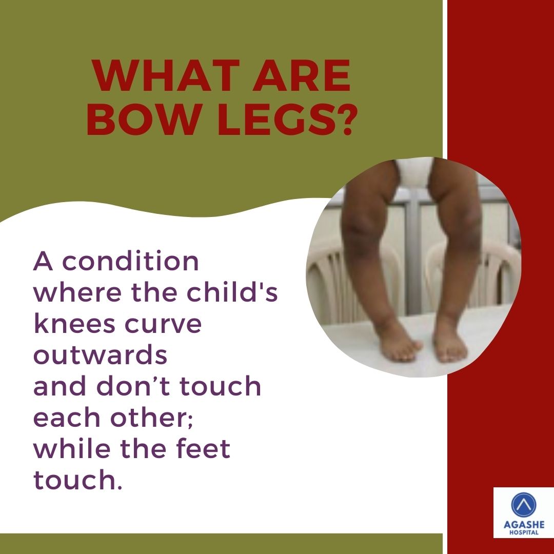 Bow legs Agashe Hospital