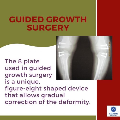 guided growth surgery with eight plate